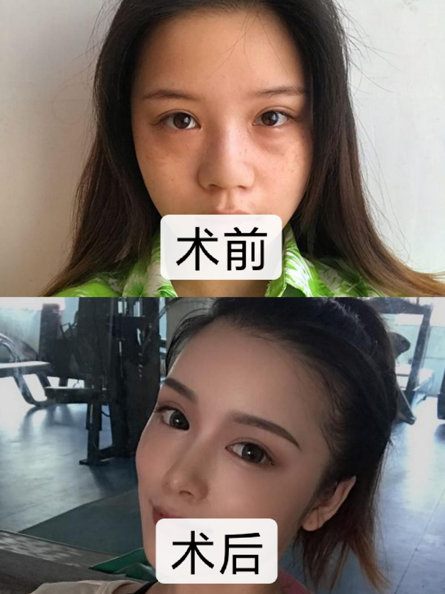 妮蔻,更懂爱美的你坐标:成都项目:隆鼻手术我原本的鼻子的鼻翼比较大