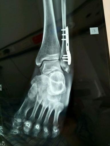 案例踝关节骨折外踝远端腓骨骨折