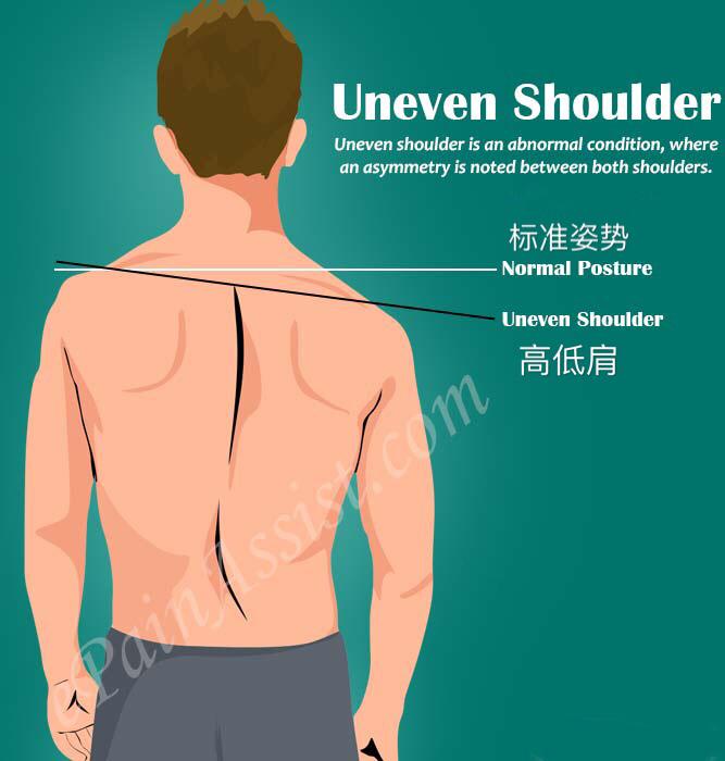 高低肩矫正中被忽略的重要一点——肩胛骨的位置