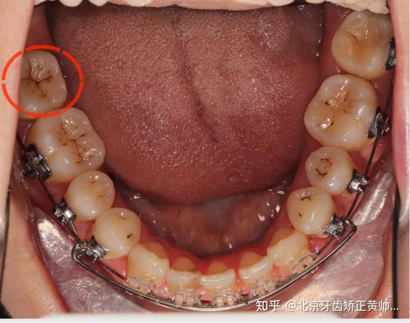 智齿矫正当大牙 代替6号牙 可以这样做吗 具体费用是多少?