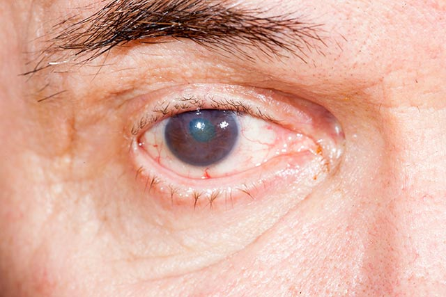 为什么糖尿病患者容易患白内障和其它眼部疾病