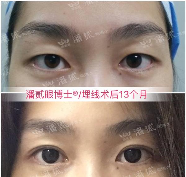 双眼皮手术究竟有哪些方法日式韩式纳米无痕生物焊接高分子双眼皮等是