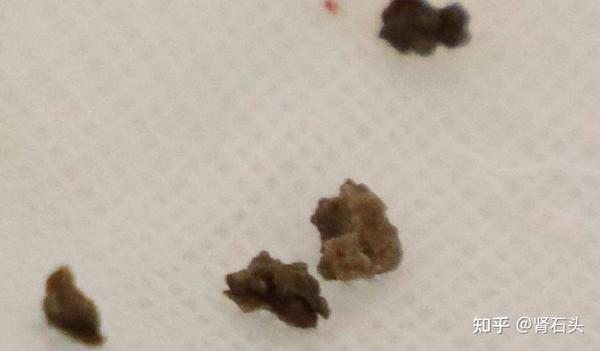 因为正常6mm的结石可以通过输尿管排出,而这种结石又很难排出输尿管