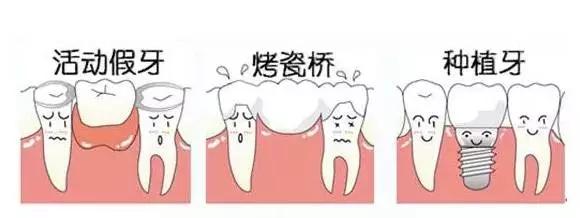 详细的缺牙修复方式优缺点对比!