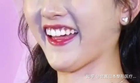 专业医生才知道的注射要点:降口角肌深部的颈阔肌以及降下唇肌相互