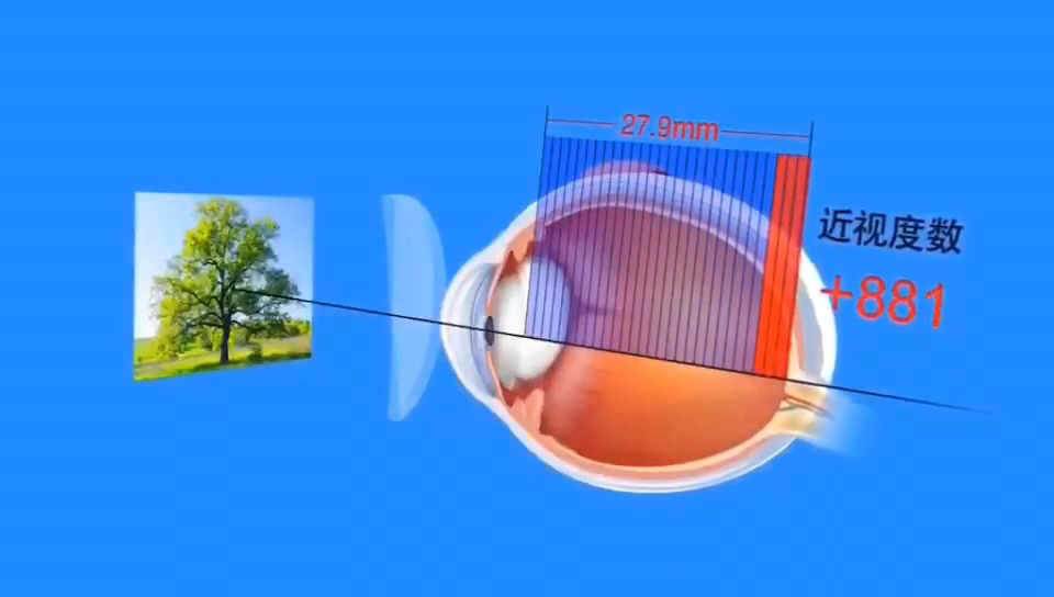 近视眼的原理就是晶状体变厚,为什么不能通过持续的按压眼球慢慢使