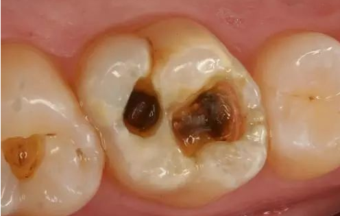 牙齿龋坏到什么程度,需要做根管治疗?