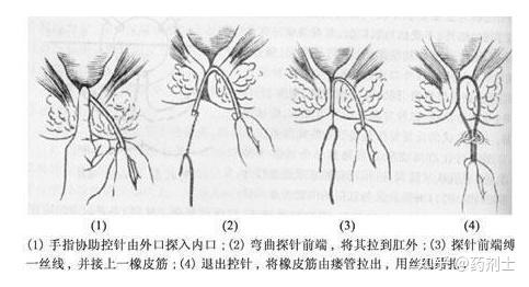 为什么你的肛瘘总是反复