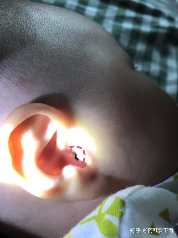 宝宝耳朵洞口长了一个白色小疙瘩,有知道怎么回事的吗