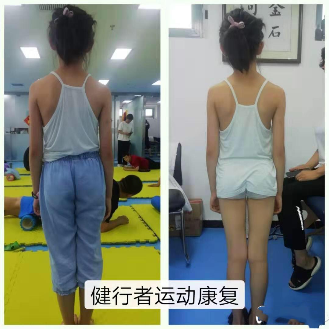 脊柱侧弯50度的后背照,脊柱侧弯度数对照表 很多家长发现自己家孩子脊柱侧弯时,已经比较明显:后背明显高低不同
