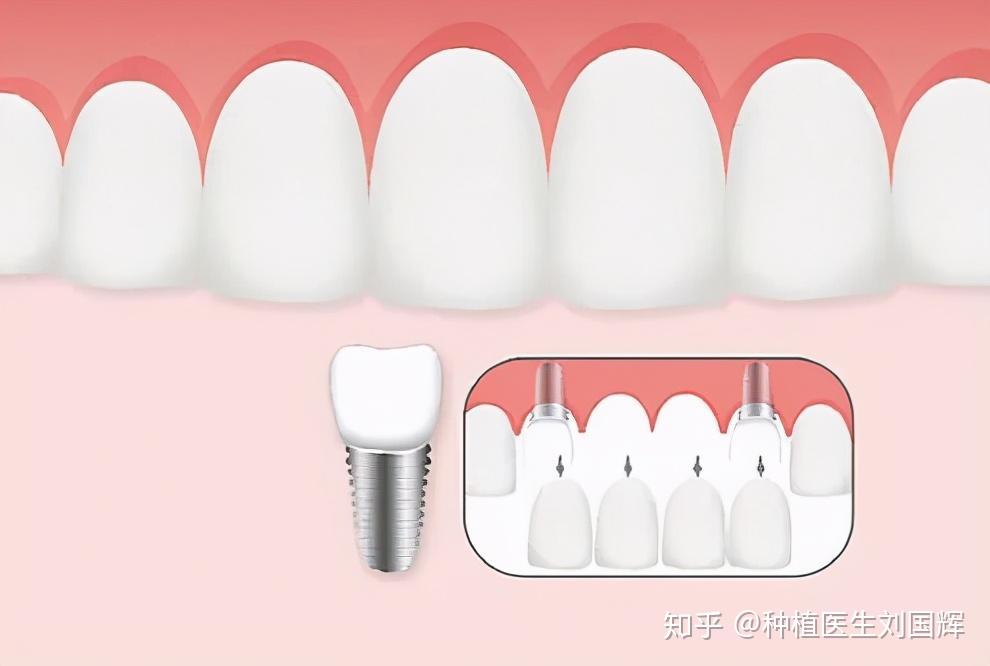 种植牙的这两个小问题,据说是大多数缺牙患者非常关心