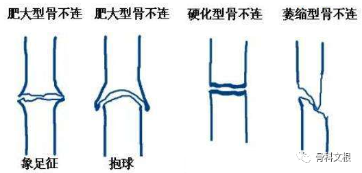 文根骨不连科普系列