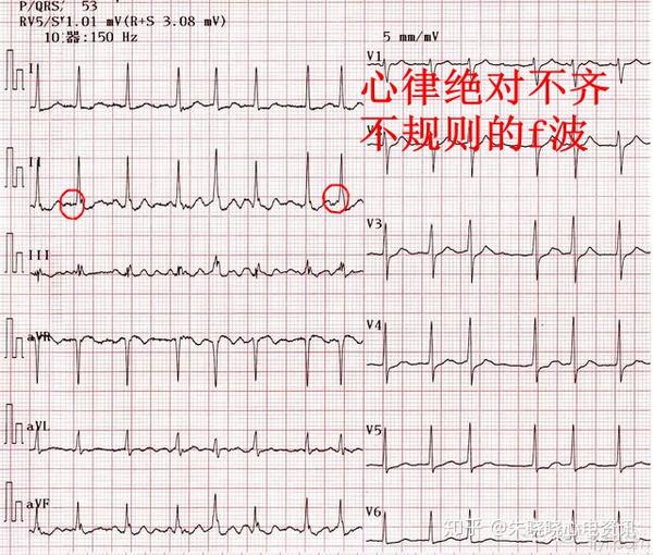 心电图还不会看教你一套简明判读口诀