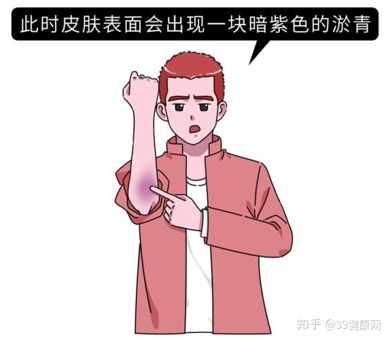 女生的膝盖总是有淤青背后的原因是什么为什么男生很少有