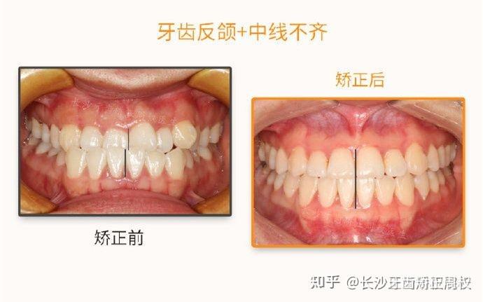 长沙牙齿矫正地包天中线不齐正畸案例