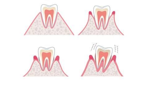 牙齿松动是怎么回事?