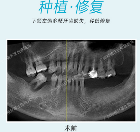 广州种植牙-陈晓兵-牙周病导致牙齿缺失数年