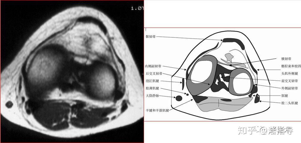 韧带的前方后角附着于髁间后窝后交叉韧带的前方边缘与内侧关节囊相连