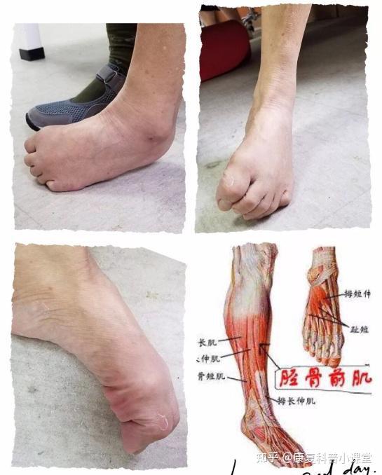 足下垂能通过矫形手术彻底治愈吗?