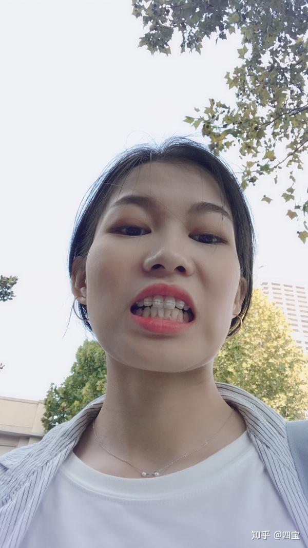 记录缺牙带牙套的我