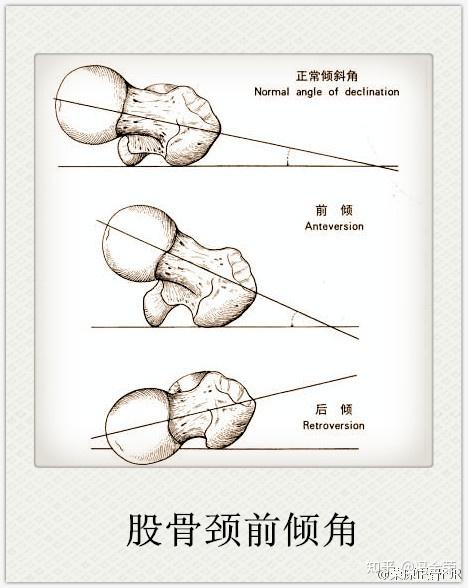 67○ "股骨颈前倾角"自股骨头中心沿股骨颈画一条轴线与股骨下端两