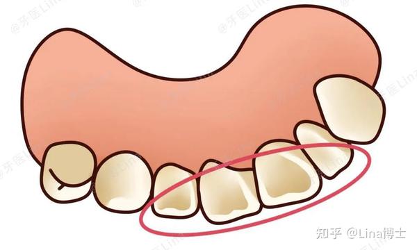可以舔一下你们的门牙以及旁边的两颗牙齿,看是不是铲状的.