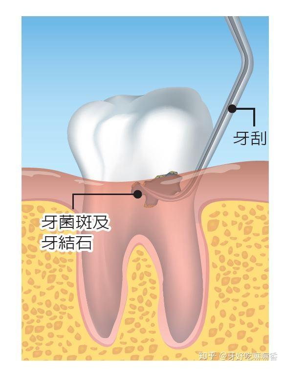 洗过牙了为什么偏偏还要做龈下刮治