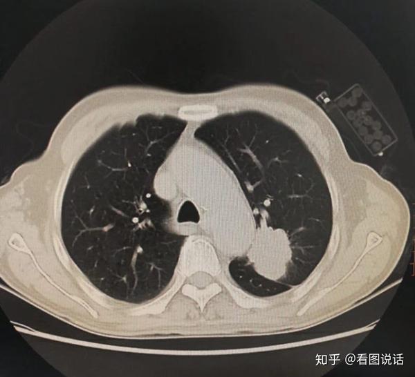 拍肺部ct能看出抽烟吗?