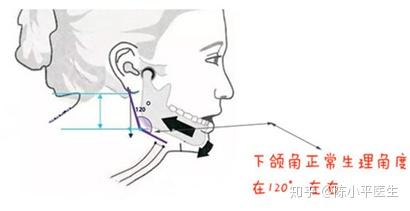 下颌角整形的这些知识你知道多少