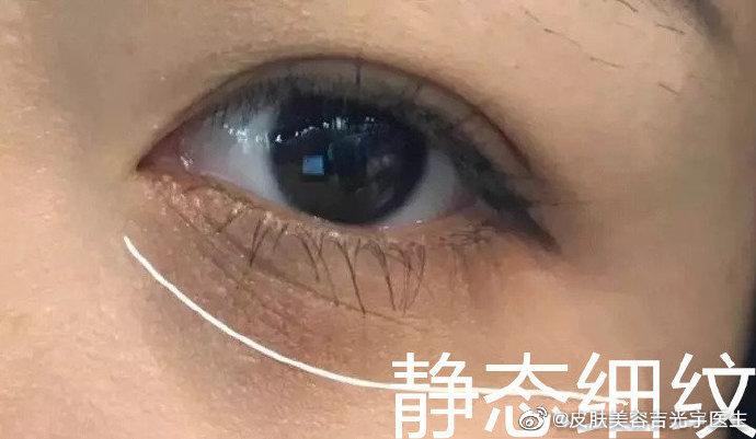吉光宇主任对眼底的干纹细纹的改善方法解析