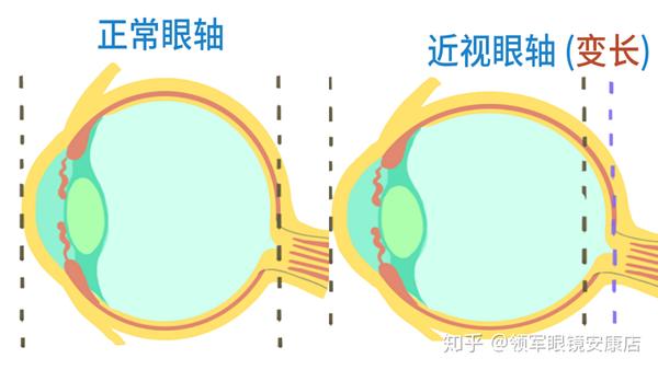 因为:近视的度数不仅受眼轴的影响,同时也受角膜或晶状体曲率,及屈光