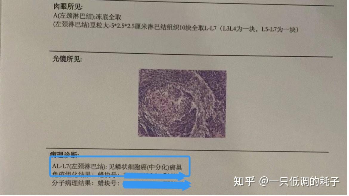 肿瘤引起的淋巴结肿大是什么样子的淋巴结融合