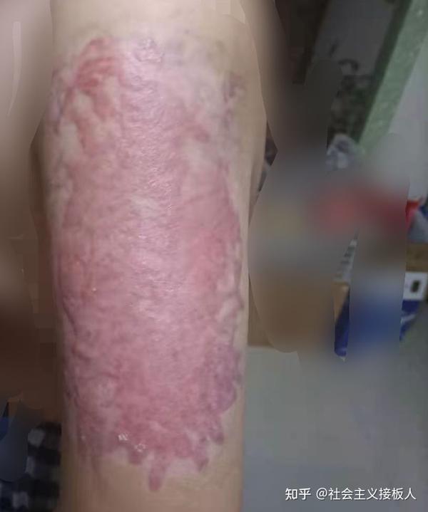 这样的烫伤疤痕消防员招录体检能过吗