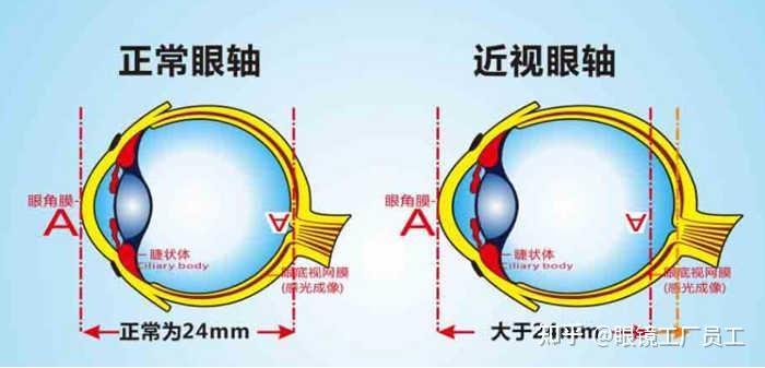 眼轴长度和近视是什么关系