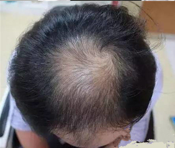 m型脱发和o型脱发到底哪个更严重