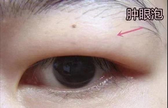 不同类型肿眼泡应该如何改善割双眼皮就可以吗