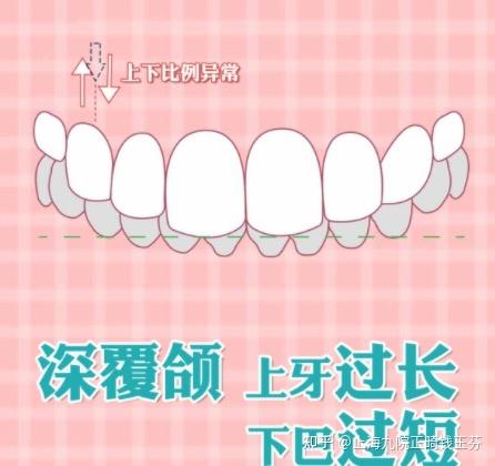 上海牙齿矫正 | 牙齿常见的"深咬"症状,如何通过正畸解决?