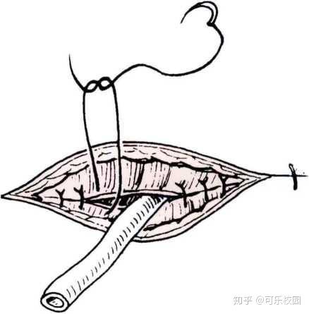 甲状腺舌管囊肿(瘘管)切除术