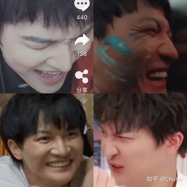 周深的鼻子形态分析(2)——硅胶假体隆鼻时期