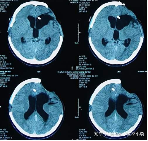 明星发型师车祸开颅术后脑膨出及脑室分流后脑内陷偏瘫因在李小勇