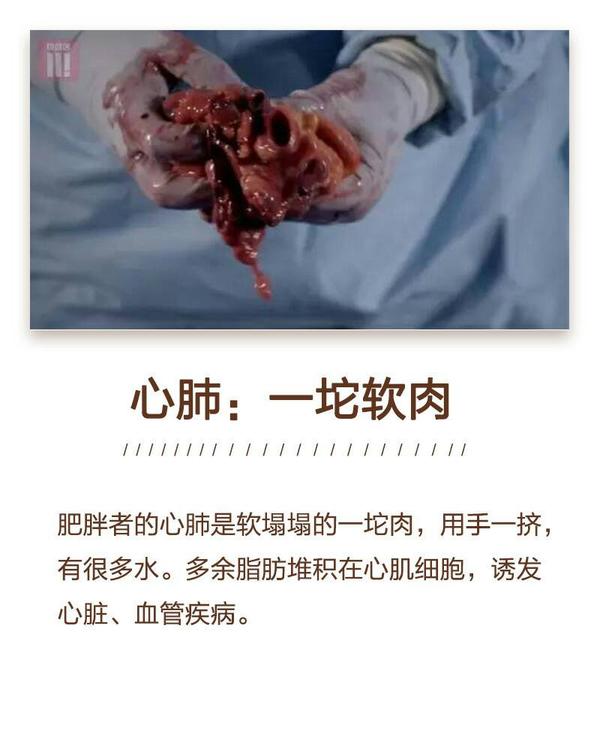 英国bbc曾纪录了医生解剖一个200斤肥胖女尸的过程,看看这些肥胖的