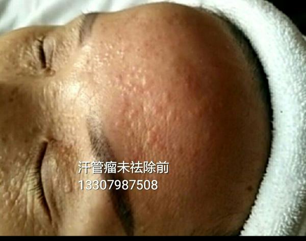 汗管瘤祛除最新方法