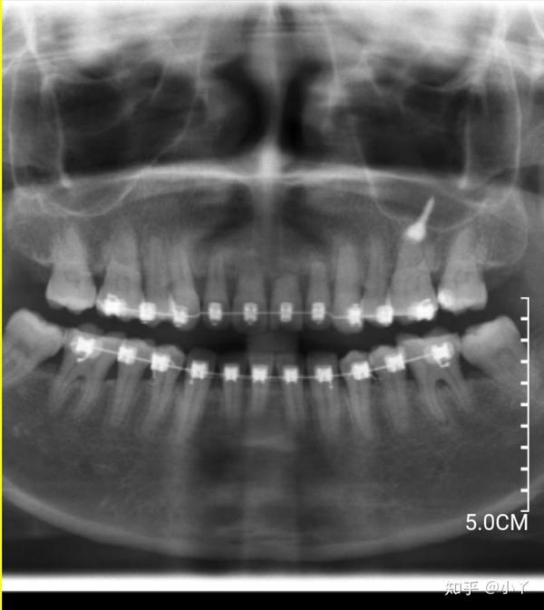 牙就要掉了!正畸快二年半,昨天拍片发现牙根吸收