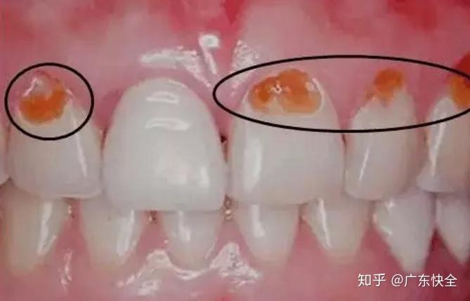 2到4.9之间.当口腔环境ph值低于5.5时,牙齿就会"脱钙.