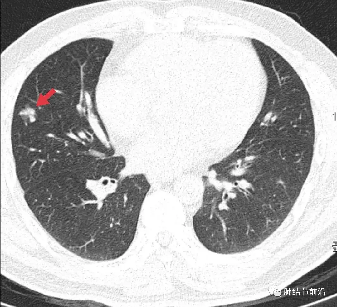 肺结节(早期肺腺癌)中恶性程度最高的病理亚型:微乳头