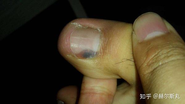 指甲下面长皮肤癌,叫做黑色素瘤