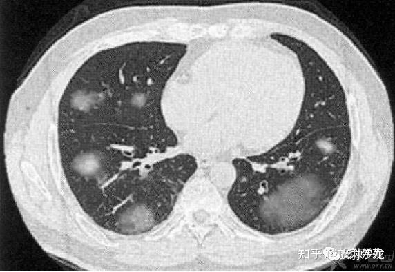 肺部wegener肉芽肿影像征象分析