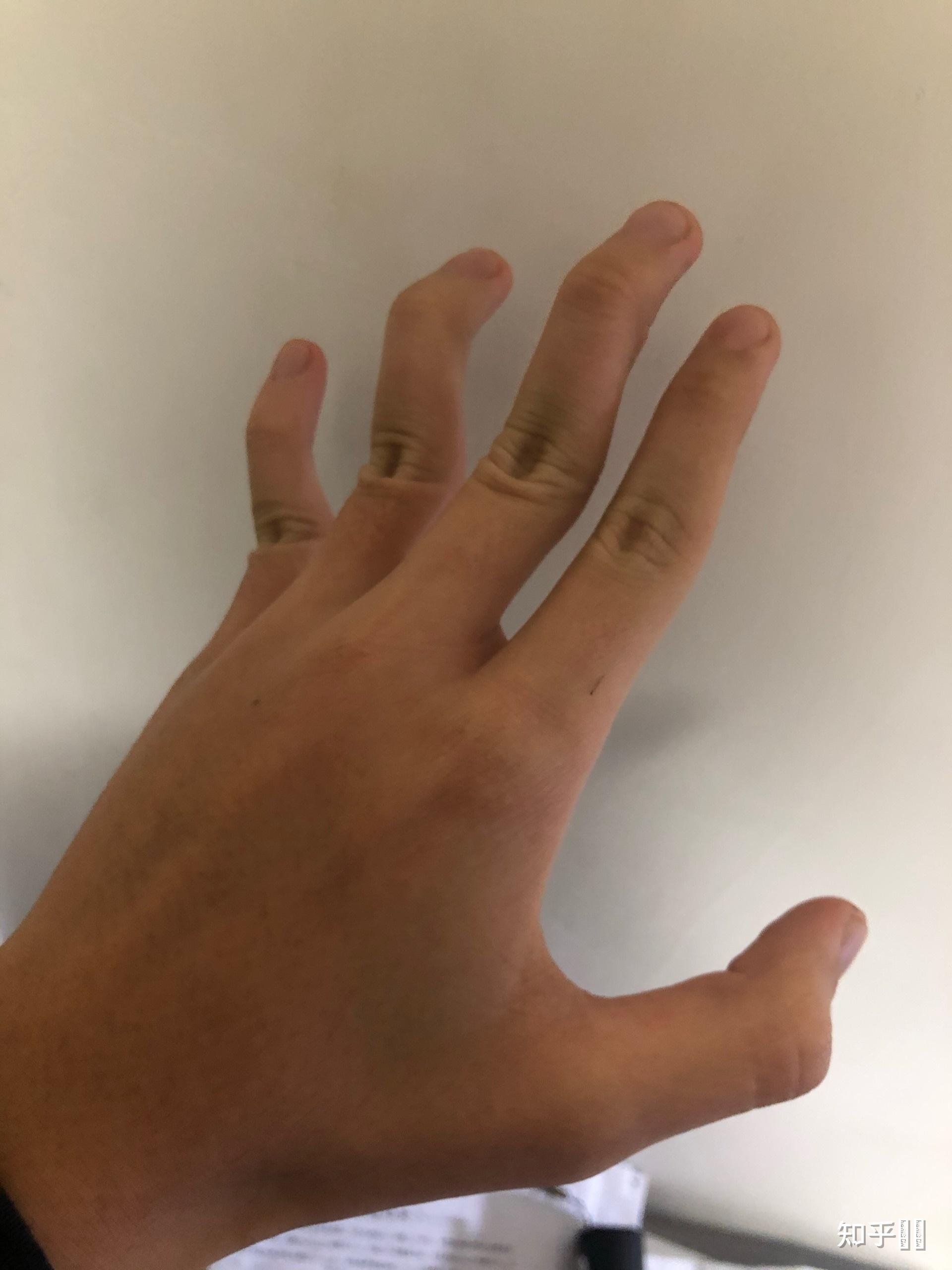 手指十个指头第一关节可反向弯曲90度正常吗