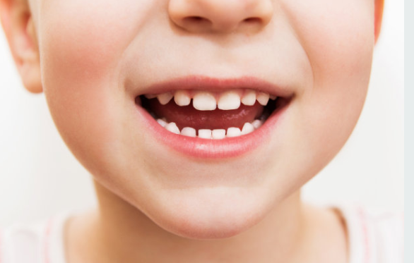 海德堡联合口腔-正畸院长 牙齿不整齐的问题,换牙季的小朋友中是非常