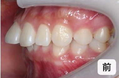 "龅牙"是深覆颌还是深覆盖,两者如何区分?